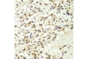 Immunohistochemistry of paraffin-embedded human kidney cancer using LHX4 antibody (ABIN6128183, ABIN6143193, ABIN6143194 and ABIN6224097) at dilution of 1:100 (40x lens). (LHX4 Antikörper  (AA 121-390))