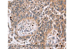 Immunohistochemistry of Human lung cancer using FUCA1 Polyclonal Antibody at dilution of 1:30 (FUCA1 Antikörper)