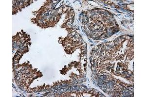 Immunohistochemical staining of paraffin-embedded Adenocarcinoma of ovary tissue using anti-TUBA8 mouse monoclonal antibody.