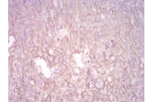 Immunohistochemical analysis of paraffin-embedded ovarian cancer tissues using CK5 mouse mAb with DAB staining. (Cytokeratin 5 Antikörper  (AA 258-357))