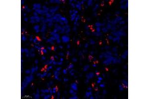 Immunofluorescence of paraffin embedded human esophagus cancer using c-caspase3 (ABIN7073336) at dilution of 1:500 (400x lens) (Caspase 3 Antikörper  (cleaved))