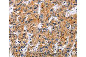 Immunohistochemistry of Human gastric cancer using TNFRSF9 Polyclonal Antibody at dilution of 1:50 (CD137 Antikörper)