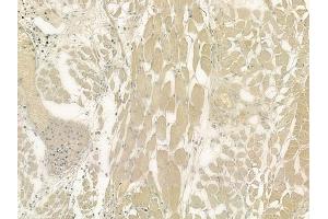 ABIN6263594 and ABIN6276436 at 1/100 staining human lung adenocarcinoma by IHC-P. (NEK8 Antikörper  (Internal Region))