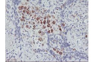 Immunohistochemical staining of paraffin-embedded Carcinoma of Human lung tissue using anti-ACSF2 mouse monoclonal antibody. (ACSF2 Antikörper)
