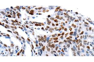 Immunohistochemistry of paraffin-embedded Human ovarian cancer using MUTYH Polyclonal Antibody at dilution of 1:60