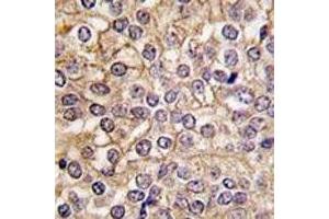 IHC analysis of FFPE human prostate carcinoma tissue stained with IL1R1 antibody (IL1R1 Antikörper  (AA 474-503))