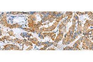 Immunohistochemistry of paraffin-embedded Human thyroid cancer tissue using FBXO8 Polyclonal Antibody at dilution of 1:40(x200)