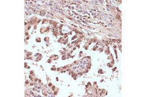 Immunohistochemistry of paraffin-embedded human lung cancer using Rad50 antibody (ABIN3017329, ABIN3017330, ABIN3017331 and ABIN6220043) at dilution of 1:100 (40x lens). (RAD50 Antikörper  (AA 1-100))