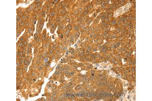 Immunohistochemistry of Human breast cancer using TMEFF2 Polyclonal Antibody at dilution of 1:35 (TMEFF2 Antikörper)