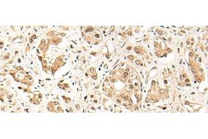 Immunohistochemistry of paraffin-embedded Human prost ate cancer tissue using GPR139 Polyclonal Antibody at dilution of 1:50(x200) (GPR139 Antikörper)