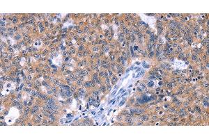 Immunohistochemistry of paraffin-embedded Human ovarian cancer tissue using ZNF395 Polyclonal Antibody at dilution 1:40 (ZNF395 Antikörper)