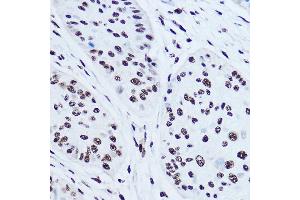 Immunohistochemistry of paraffin-embedded human esophageal cancer using SSB Rabbit pAb (ABIN3015264, ABIN3015265, ABIN3015266 and ABIN6213909) at dilution of 1:300 (40x lens). (SSB Antikörper  (AA 166-408))