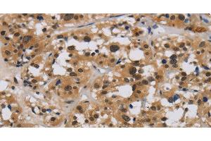 Immunohistochemistry of paraffin-embedded Human thyroid cancer tissue using E2F4 Polyclonal Antibody at dilution 1:40 (E2F4 Antikörper)