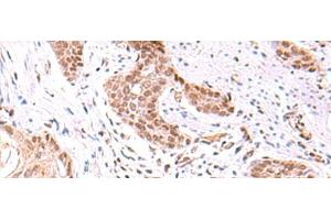 Immunohistochemistry of paraffin-embedded Human esophagus cancer tissue using TRMT12 Polyclonal Antibody at dilution of 1:80(x200) (TRMT12 Antikörper)