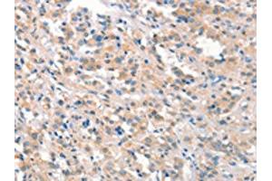 The image on the left is immunohistochemistry of paraffin-embedded Human thyroid cancer tissue using ABIN7191162(KCNB1 Antibody) at dilution 1/40, on the right is treated with synthetic peptide. (Kv2.1/KCNB1 Antikörper)