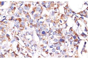 Immunohistochemistry of paraffin-embedded Human breast cancer using STOML2 Polyclonal Antibody at dilution of 1:100 (40x lens). (STOML2 Antikörper)