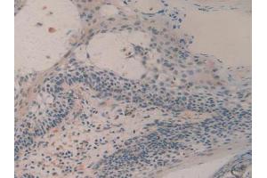 IHC-P analysis of Human Skin Cancer Tissue, with DAB staining. (H2AFY Antikörper  (AA 109-369))