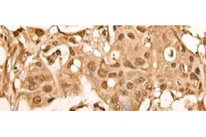 Immunohistochemistry of paraffin-embedded Human colorectal cancer tissue using BRF2 Polyclonal Antibody at dilution of 1:40(x200) (BRF2 Antikörper)
