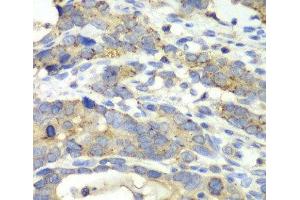 Immunohistochemistry of paraffin-embedded Human gastric cancer using CHMP2B Polyclonal Antibody at dilution of 1:100 (40x lens). (CHMP2B Antikörper)