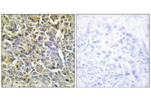 Immunohistochemistry analysis of paraffin-embedded human lung carcinoma tissue using COL6A2 antibody. (COL6A2 Antikörper  (Internal Region))