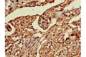 Immunohistochemistry of paraffin-embedded human lung cancer using ABIN7164763 at dilution of 1:100 (PRR11 Antikörper  (AA 1-360))
