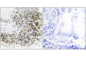 Immunohistochemistry analysis of paraffin-embedded human lung carcinoma tissue, using TRPS1 Antibody. (TRPS1 Antikörper  (AA 121-170))