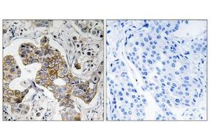 Immunohistochemistry analysis of paraffin-embedded human breast carcinoma tissue using KCNK15 antibody. (KCNK15 Antikörper  (C-Term))