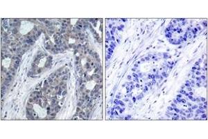 Immunohistochemistry analysis of paraffin-embedded human breast carcinoma, using IRS-1 (Phospho-Ser636) Antibody. (IRS1 Antikörper  (pSer636))