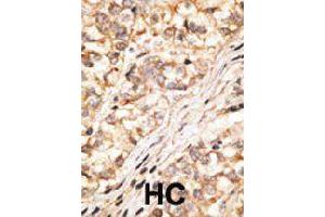 Formalin-fixed and paraffin-embedded human hepatocellular carcinoma tissue reacted with GJD2 polyclonal antibody  , which was peroxidase-conjugated to the secondary antibody, followed by DAB staining. (GJD2 Antikörper  (C-Term))