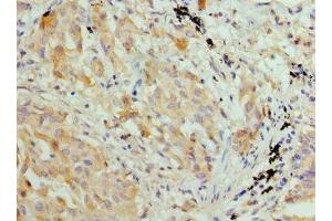 Immunohistochemistry of paraffin-embedded human lung cancer using ABIN7155429 at dilution of 1: 100 (HIST2H3A Antikörper  (AA 108-136))
