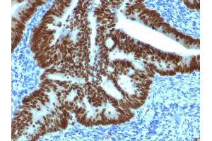 Formalin-fixed, paraffin-embedded human Colon Carcinoma stained with CDX2 Mouse Monoclonal Antibody (CDX2/1690). (CDX2 Antikörper  (AA 150-249))
