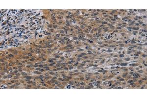 Immunohistochemistry of paraffin-embedded Human cervical cancer tissue using CCL1 Polyclonal Antibody at dilution 1:50 (CCL1 Antikörper)