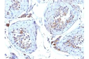 Formalin-fixed, paraffin-embedded human Testicular Carcinoma stained with SHBG Mouse Monoclonal Antibody (SHBG/245). (SHBG Antikörper)