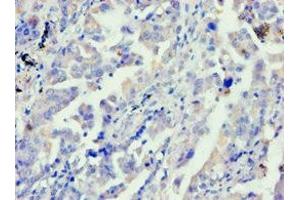 Immunohistochemistry of paraffin-embedded human lung cancer using ABIN7144040 at dilution of 1:100 (FE65 Antikörper  (AA 361-710))