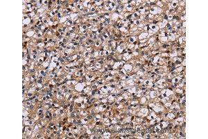 Immunohistochemistry of Human prostate cancer using NCSTN Polyclonal Antibody at dilution of 1:50 (Nicastrin Antikörper)