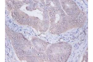 Immunohistochemistry of paraffin-embedded human colon cancer using ABIN7153940 at dilution of 1:100 (PRKCSH Antikörper  (AA 15-302))