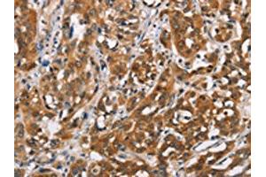 The image on the left is immunohistochemistry of paraffin-embedded Human esophagus cancer tissue using ABIN7192349(SH2B2 Antibody) at dilution 1/30, on the right is treated with synthetic peptide. (SH2B2 Antikörper)