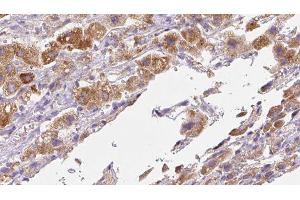 ABIN6279710 at 1/100 staining Human liver cancer tissue by IHC-P. (RFTN2 Antikörper  (C-Term))