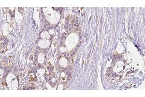 ABIN6267634 at 1/100 staining Human liver cancer tissue by IHC-P. (GRIN2B Antikörper  (pTyr1474))