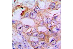 Immunohistochemical analysis of IRS1 (pS636) staining in human lung cancer formalin fixed paraffin embedded tissue section. (IRS1 Antikörper  (pSer636))