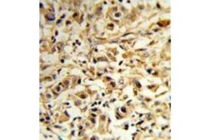 Formalin-fixed and paraffin-embedded human breast carcinoma reacted with MAT2B Antibody (N-term) followed which was peroxidase-conjugated to the secondary antibody, followed by DAB staining.