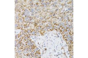 Immunohistochemistry of paraffin-embedded human lung cancer using PDYN antibody (ABIN2564462) at dilution of 1:100 (40x lens). (PDYN Antikörper)
