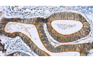 Immunohistochemistry of paraffin-embedded Human colon cancer using SULT1B1 Polyclonal Antibody at dilution of 1:30 (SULT1B1 Antikörper)