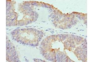 Immunohistochemistry of paraffin-embedded human endometrial cancer using ABIN7148039 at dilution of 1:100 (COCH Antikörper  (AA 20-260))