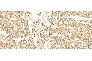 Immunohistochemistry of paraffin-embedded Human lung cancer tissue using TBPL1 Polyclonal Antibody at dilution of 1:50(x200) (TBPL1 Antikörper)