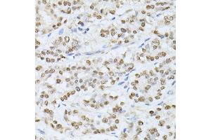 Immunohistochemistry of paraffin-embedded human colon carcinoma using SATB1 antibody. (SATB1 Antikörper)