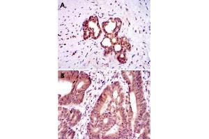 Immunohistochemical analysis of paraffin-embedded human prostate tissue (A) and colon cancer tissue (B) using OTX2 monoclonal antobody, clone 1H12C4B5  with DAB staining. (OTX2 Antikörper)