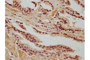 IHC image of ABIN7168592 diluted at 1:400 and staining in paraffin-embedded human prostate cancer performed on a Leica BondTM system. (SAGE1 Antikörper  (AA 3-133))