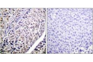Immunohistochemistry analysis of paraffin-embedded human liver carcinoma tissue, using AurB (Ab-12) Antibody. (Aurora Kinase B Antikörper  (AA 1-50))