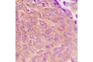 Immunohistochemical analysis of PPP2CA staining in human breast cancer formalin fixed paraffin embedded tissue section. (PPP2CA Antikörper  (C-Term))